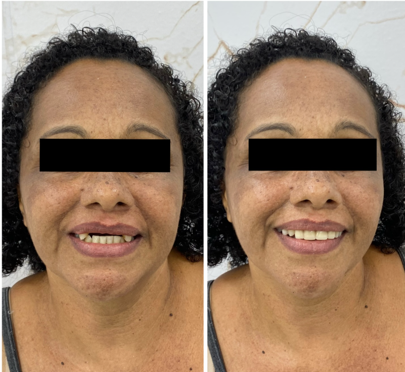 Antes e Depois - Transformação 3